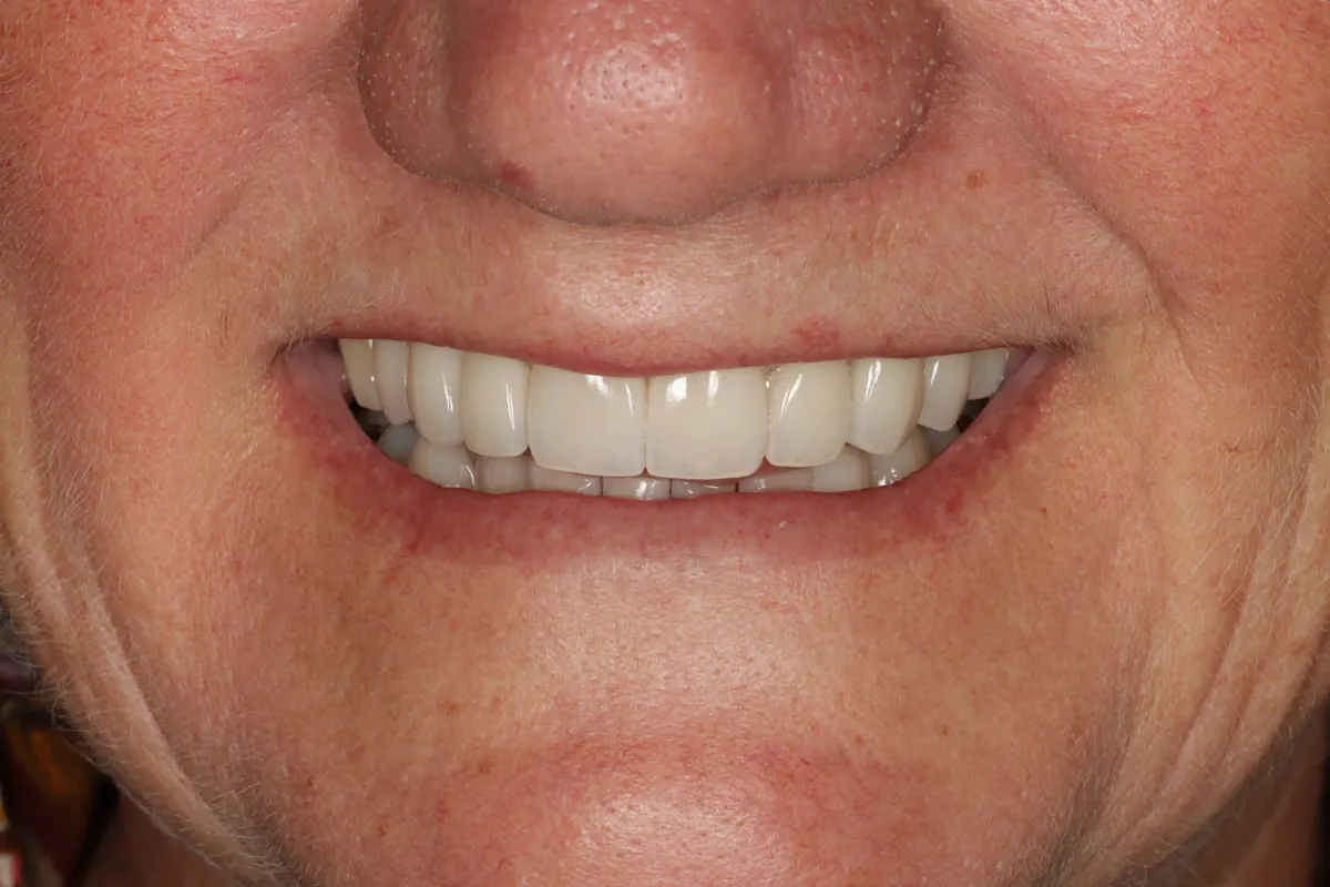 After porcelain crowns - restored smile