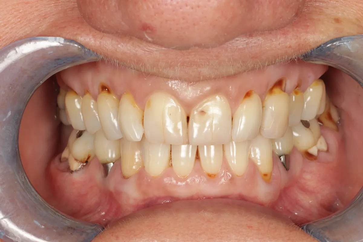 Before porcelain crowns treatment