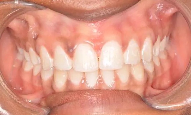 After Invisalign and whitening