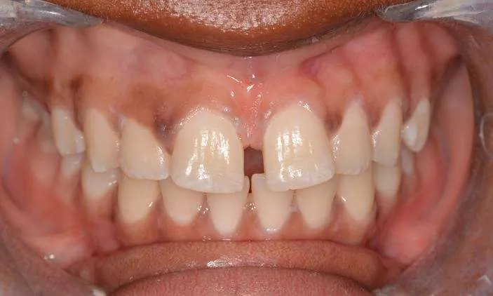 Before Invisalign and whitening