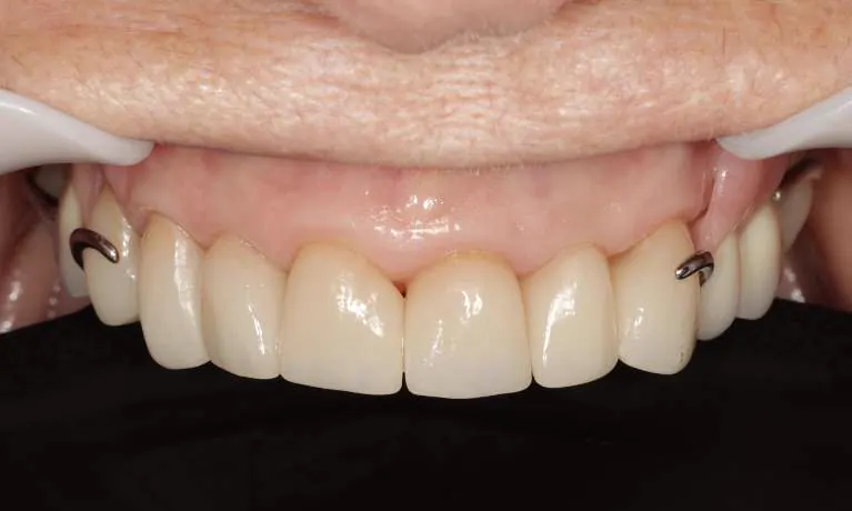 After crowns and partial - complete restoration