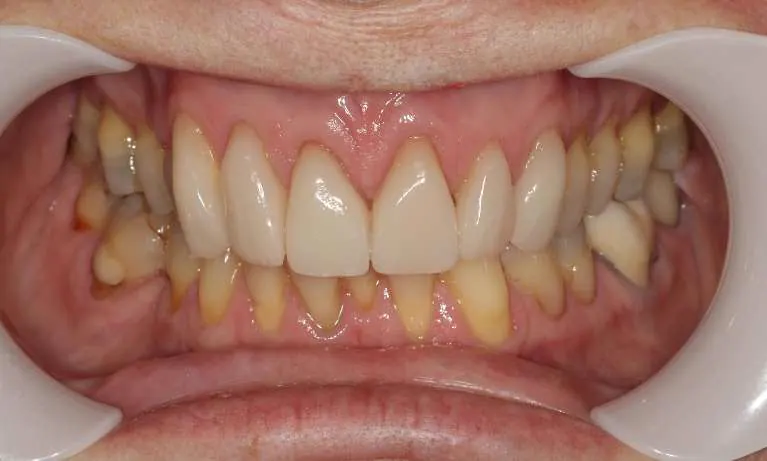 After porcelain veneers - transformed smile