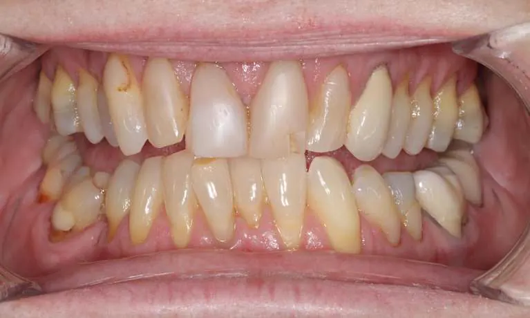 Before porcelain veneers