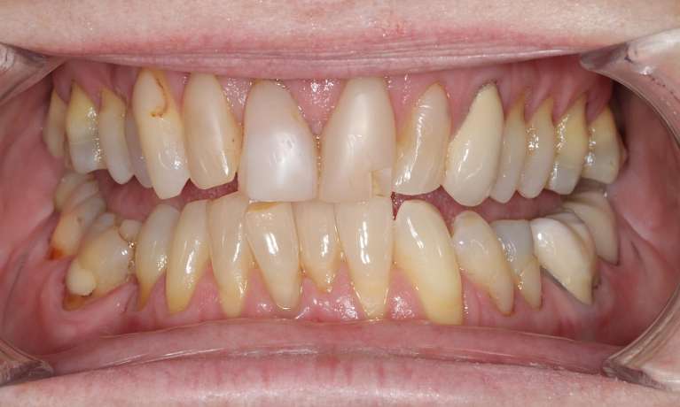 Before porcelain veneers