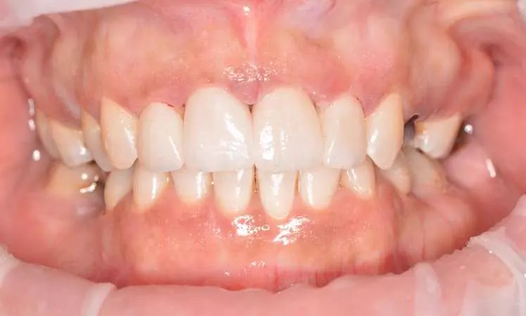 After porcelain veneers - brighter even smile