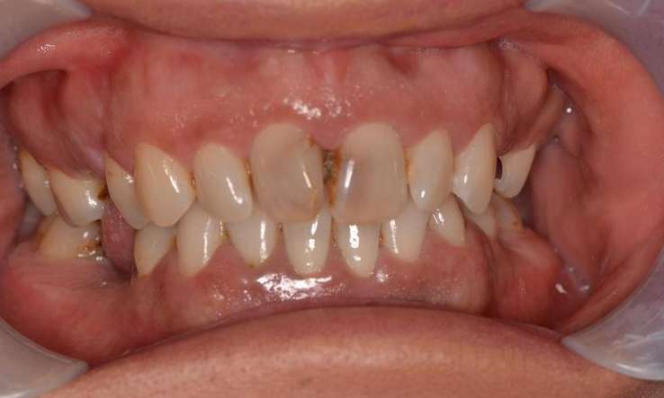 Before porcelain veneers