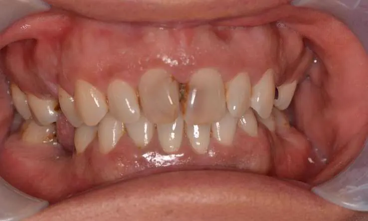 Before porcelain veneers