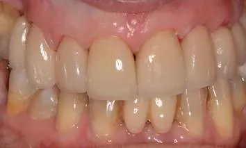 After minimal-prep veneers