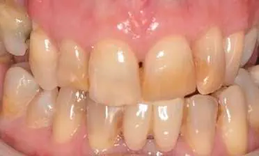 Before minimal-prep veneers