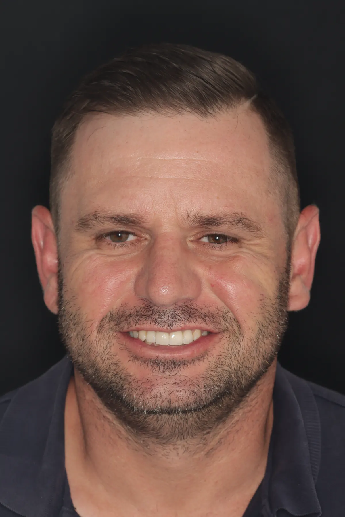After root canal with porcelain crowns