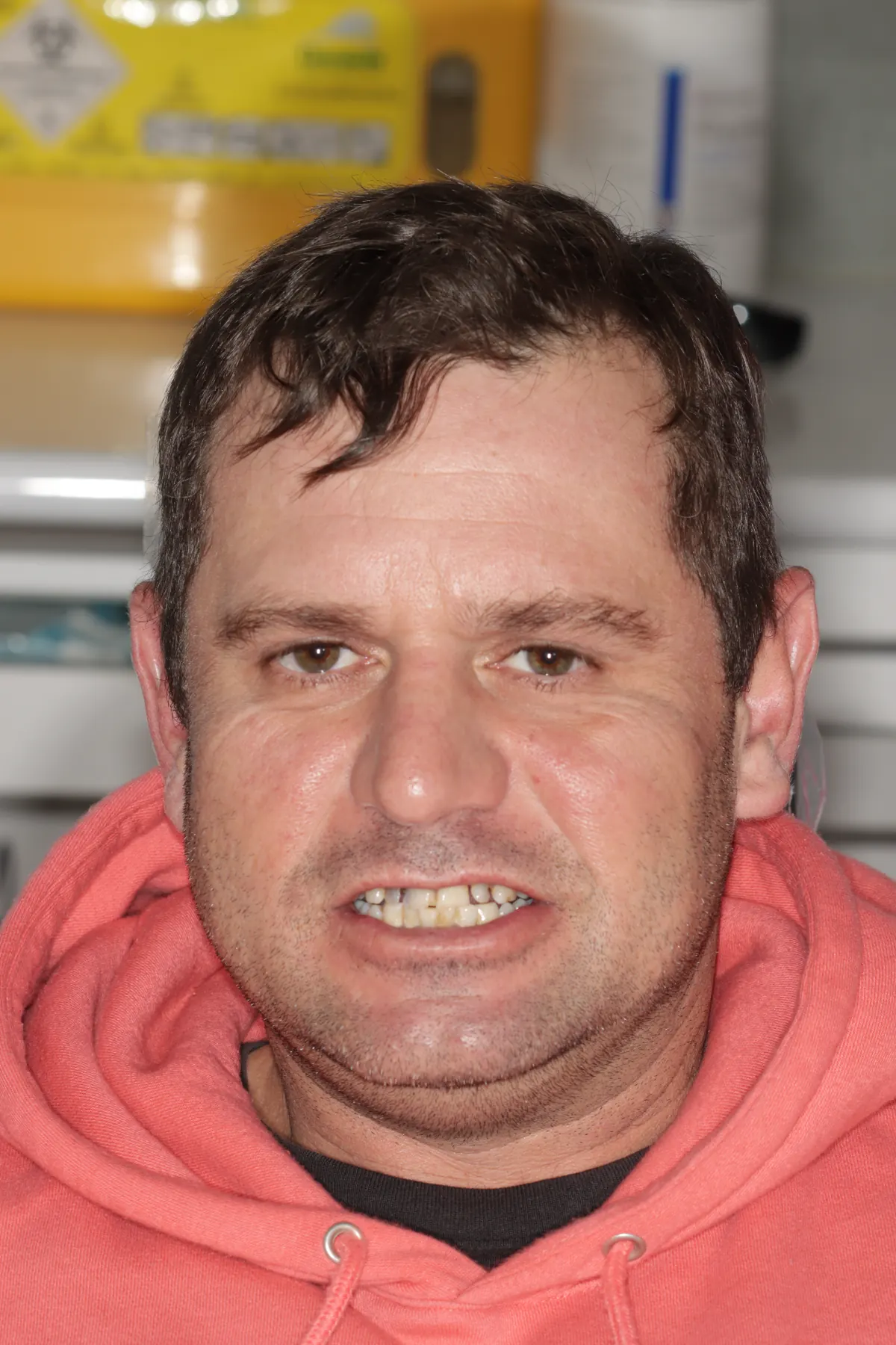 Before root canal and crowns