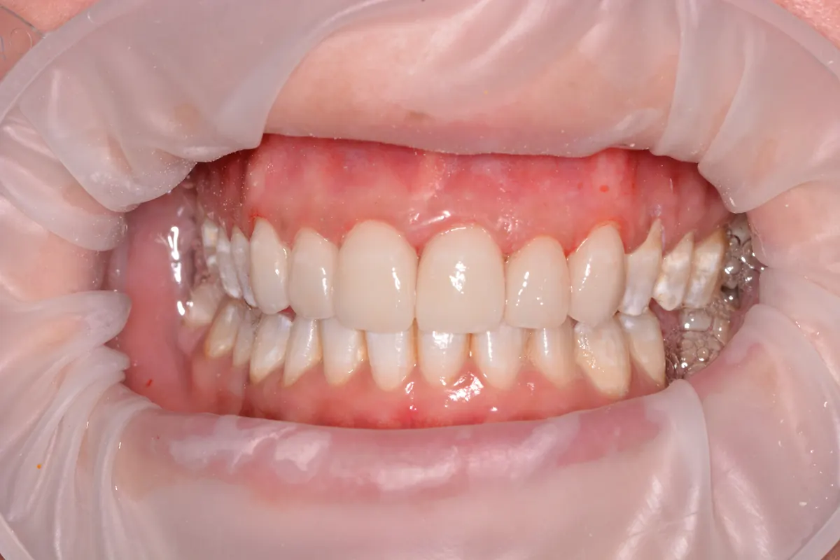 After Invisalign and porcelain veneers