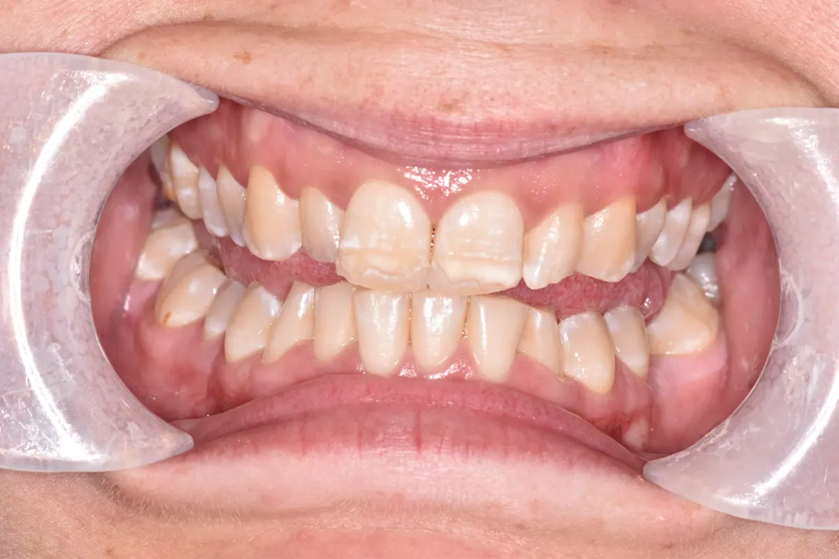 Before Invisalign and veneers