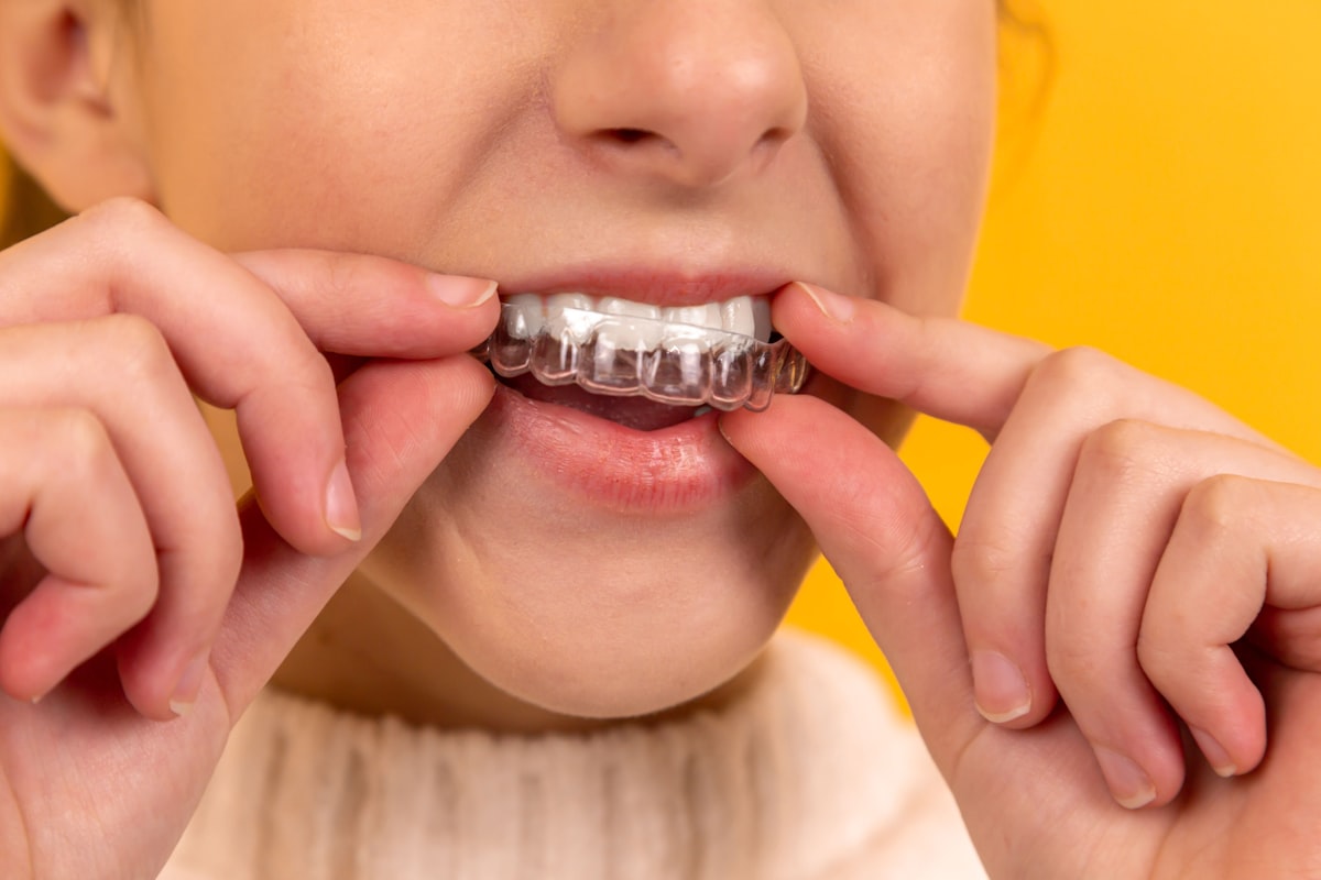 Clear aligners for discreet teeth straightening