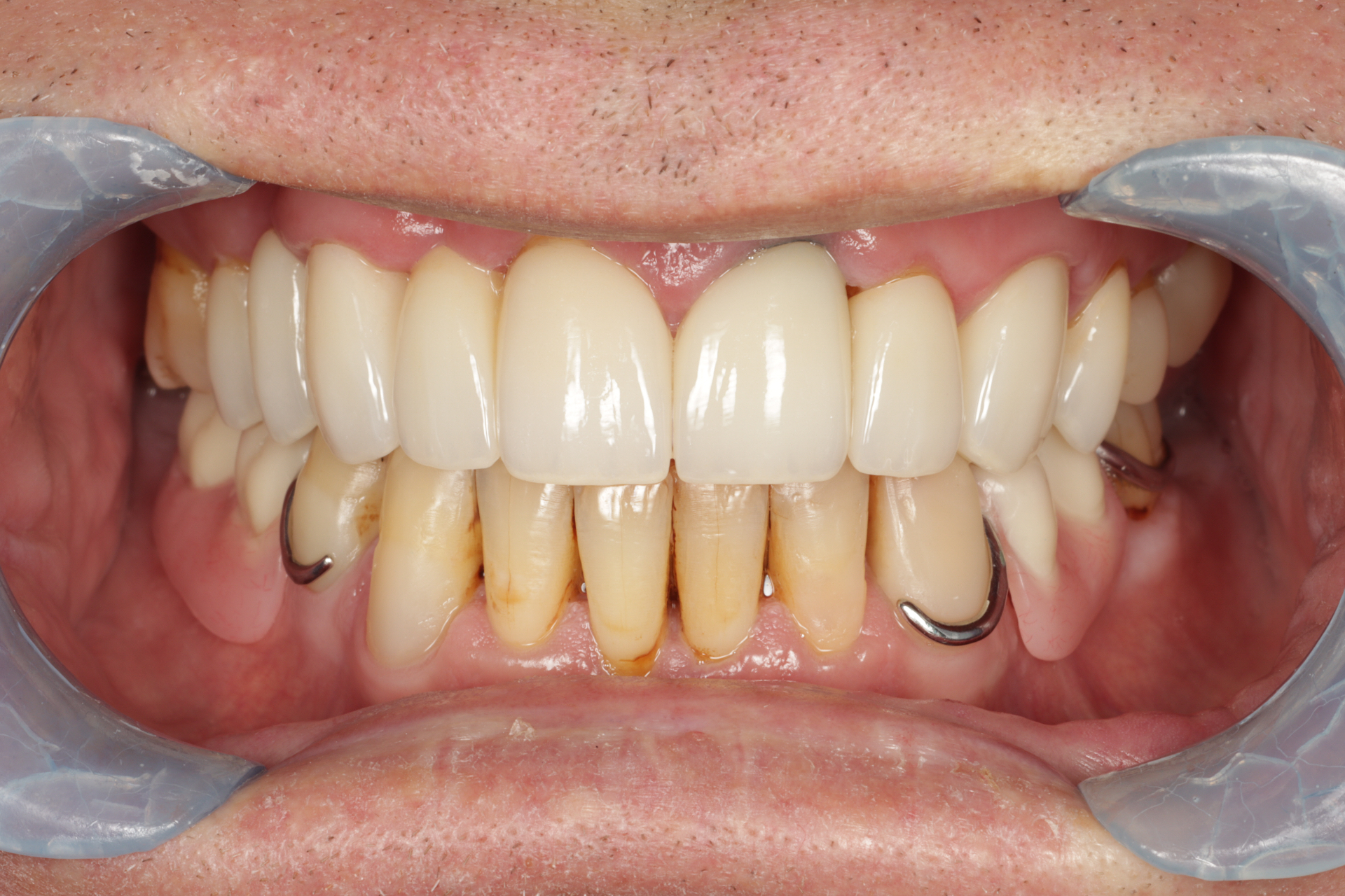 After root canal with porcelain bridge and crowns