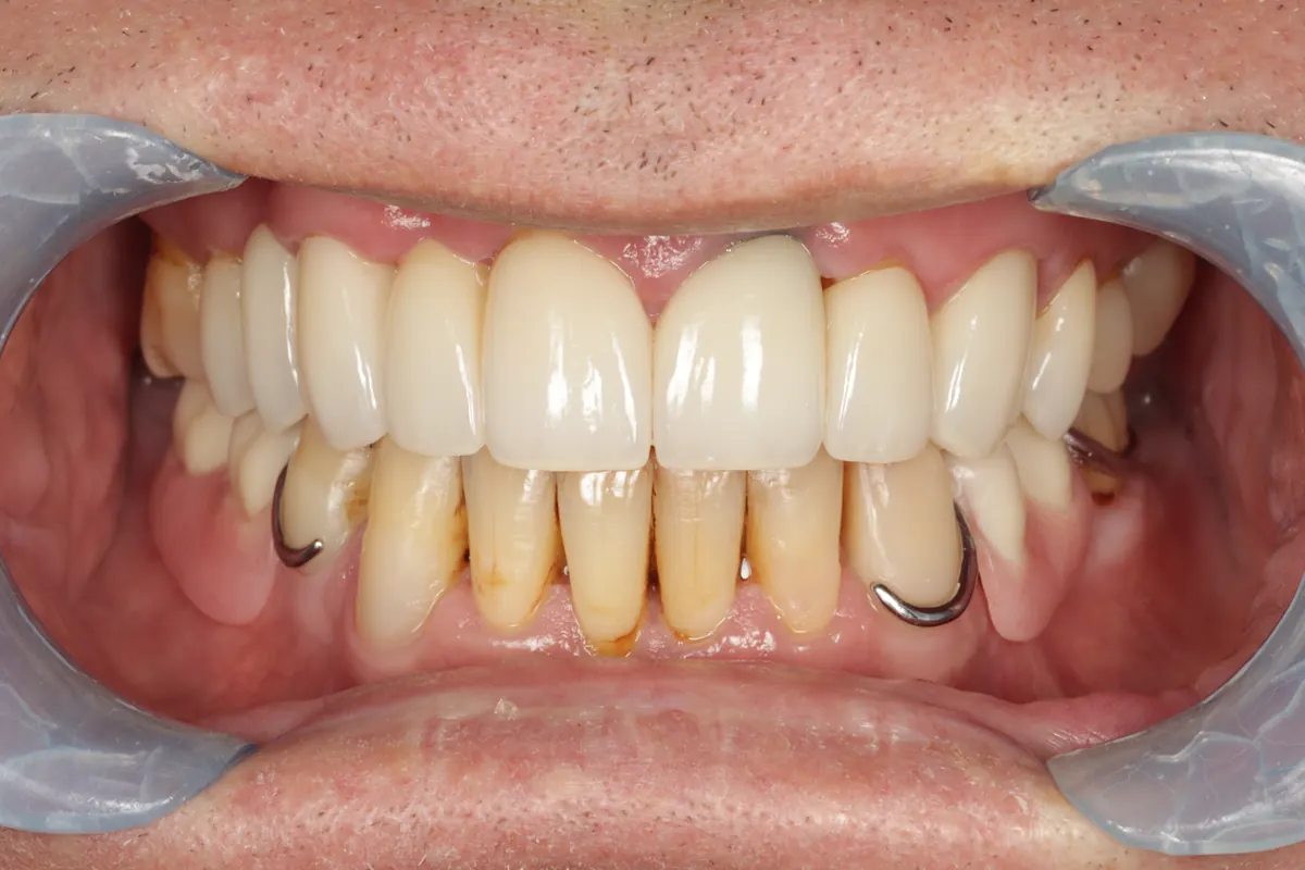 After root canal with porcelain bridge and crowns