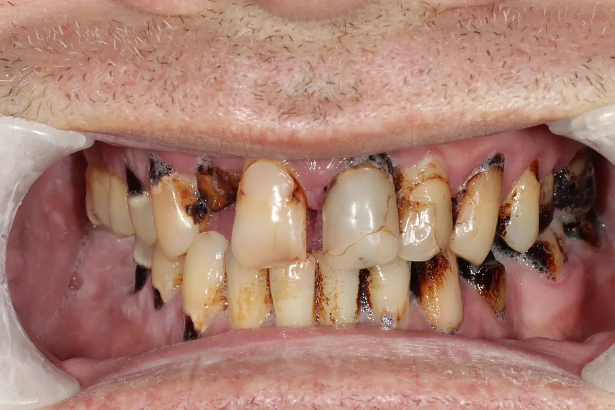 Before root canal and bridge