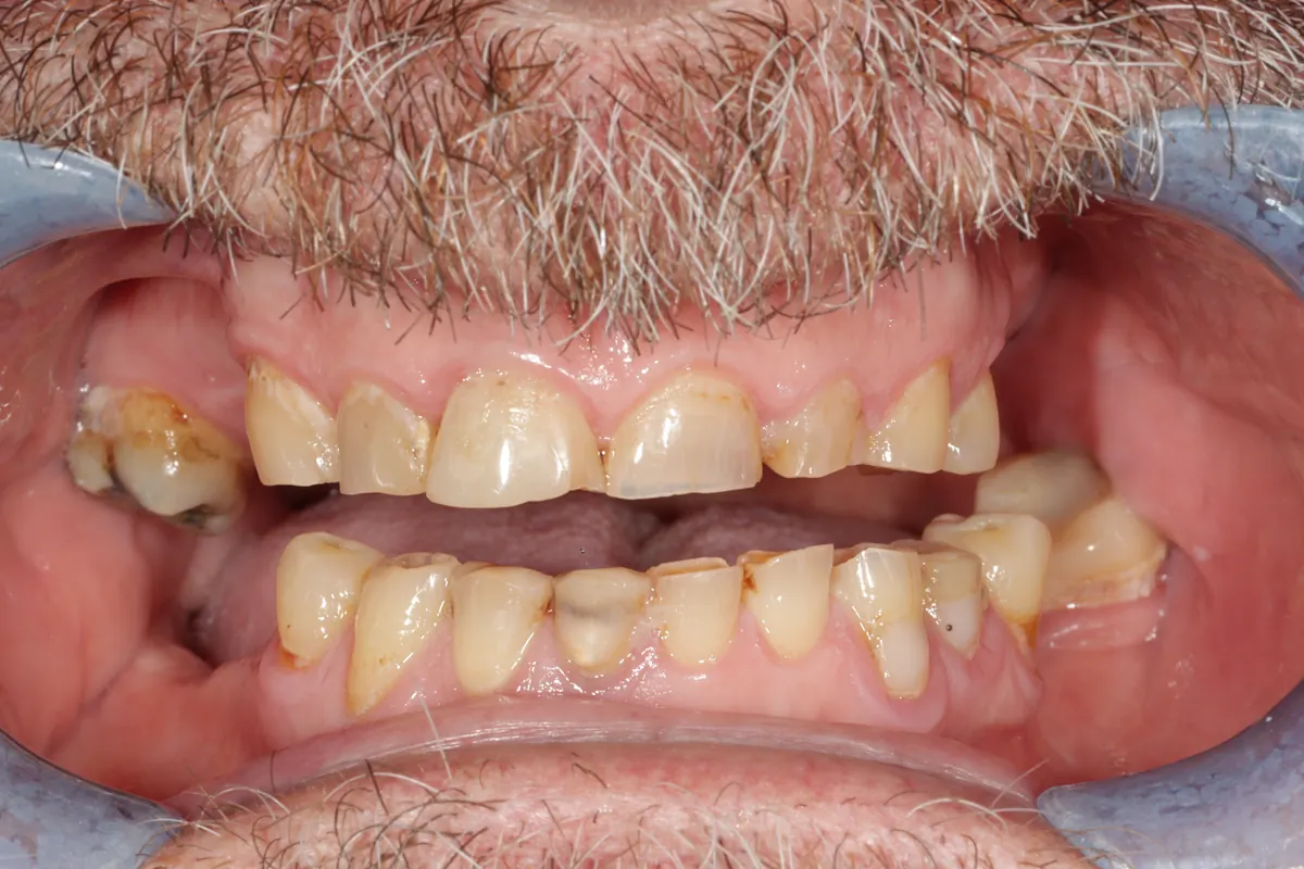 Before crowns and partial plate