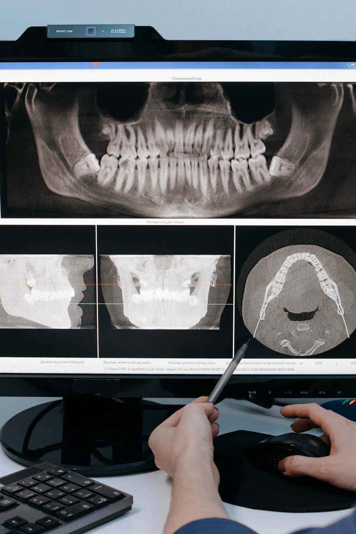 Root canal treatment procedure