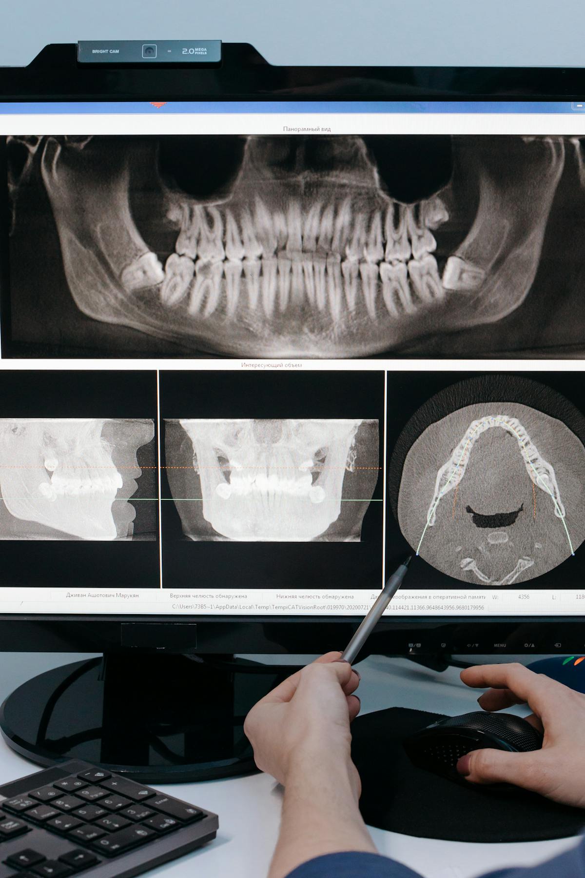 Root canal treatment procedure