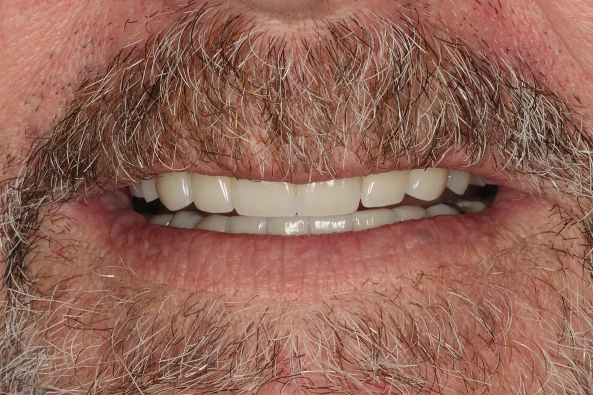 After porcelain crowns and partial chrome plate