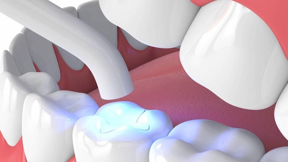 How Long Do ToothColoured Fillings Last? ToothColoured Fillings