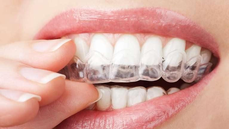 A woman putting in her Invisalign tray | Invisalign Tamworth
