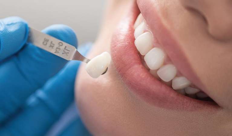 A dentist comparing veneer sizes on a patient