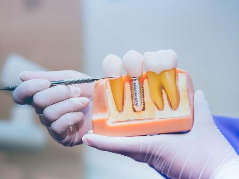 A person holding a model of a dental implant