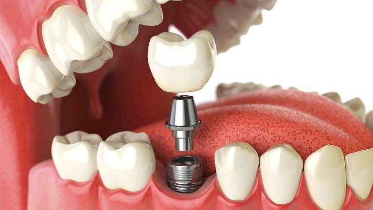 Diagram of Dental Implants from Oasis Smiles Dental