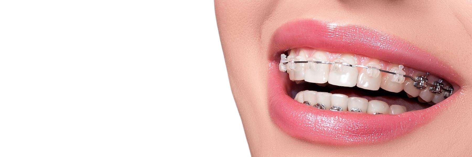 Smiling confidently with braces during a first orthodontic visit in Tamworth