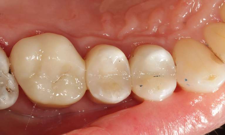 Cosmetic-Dentistry-Three-Porcelain-Crowns-After-Image