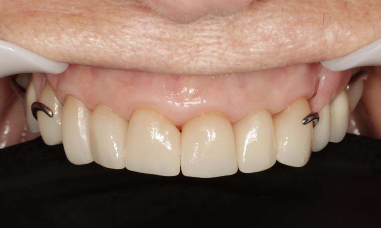 Porcelain-Crowns-and-Partial-Plate-After-Image