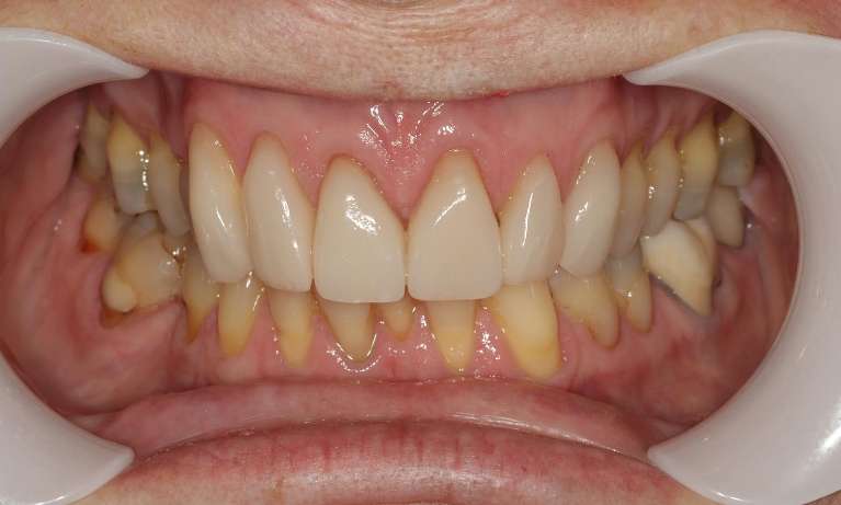 Porcelain-Veneers-After-Image