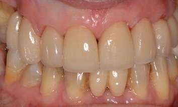 Tamworth dental patient after receiving porcelain veneers