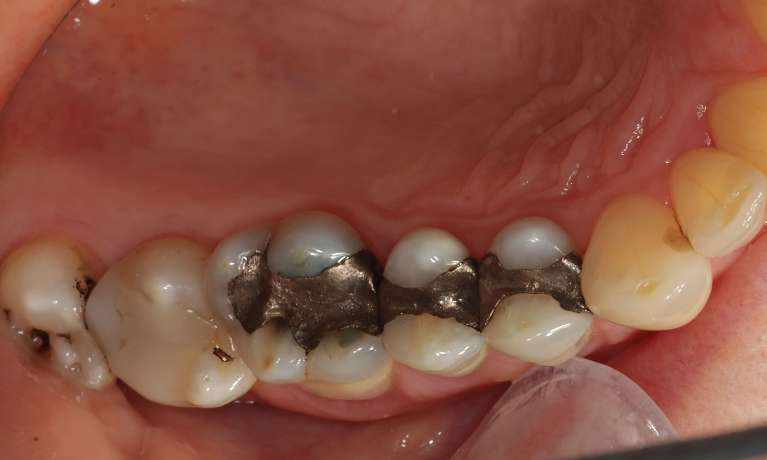 Cosmetic-Dentistry-Three-Porcelain-Crowns-Before-Image