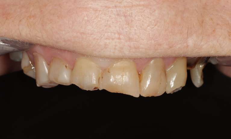 Porcelain-Crowns-and-Partial-Plate-Before-Image