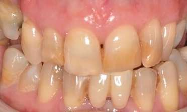 Patient with yellowing and damaged teeth